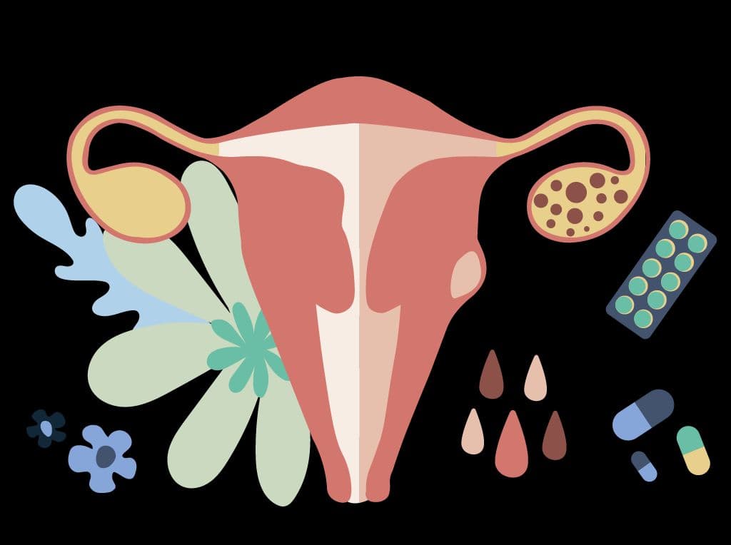 PCOS-Related Hair Loss: Treatments, Remedies and Tips
